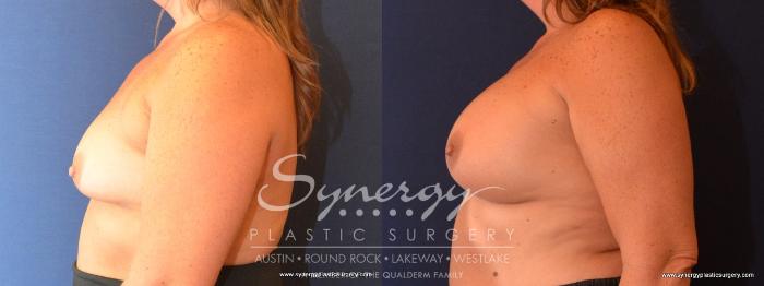 Before & After Breast Augmentation Case 439 View #2 View in Austin, TX