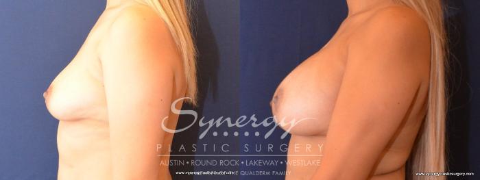 Before & After Breast Augmentation Case 441 View #2 View in Austin, TX