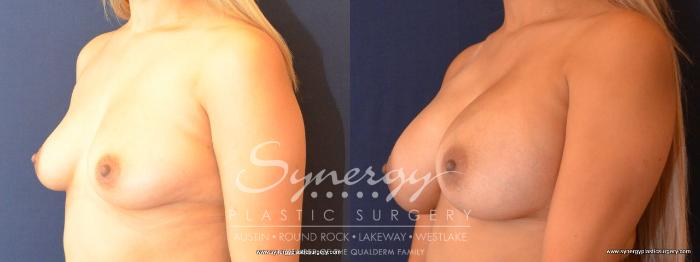 Before & After Breast Augmentation Case 441 View #3 View in Austin, TX