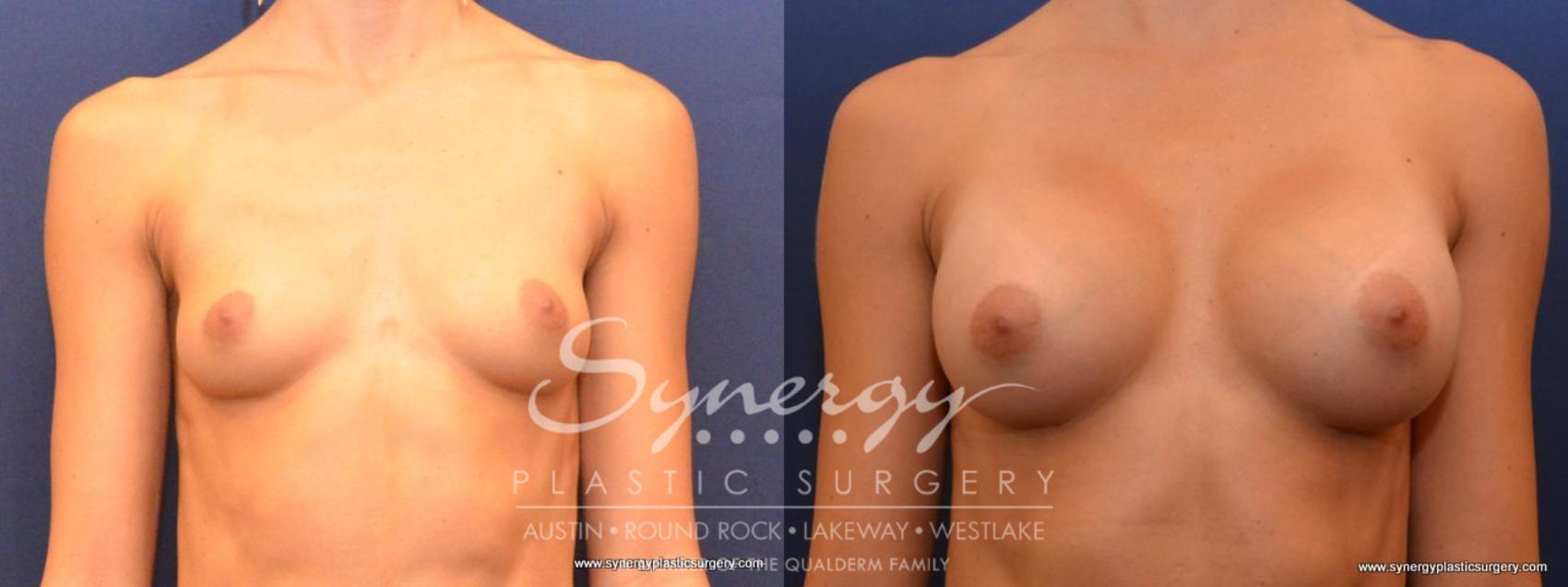 Before & After Breast Augmentation Case 442 View #1 View in Austin, TX
