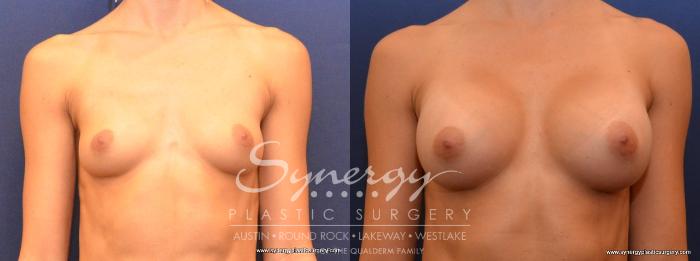 Before & After Breast Augmentation Case 442 View #1 View in Austin, TX