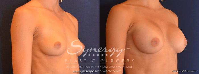 Before & After Breast Augmentation Case 442 View #3 View in Austin, TX