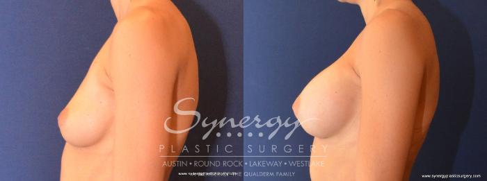 Before & After Breast Augmentation Case 442 View #4 View in Austin, TX