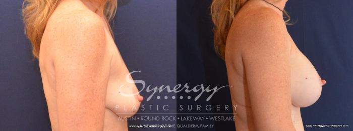 Before & After Breast Augmentation Case 443 View #2 View in Austin, TX