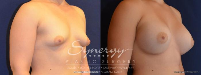 Before & After Breast Augmentation Case 444 View #3 View in Austin, TX