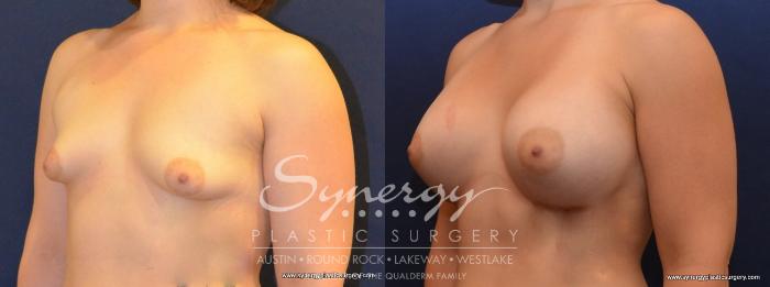 Before & After Breast Augmentation Case 444 View #5 View in Austin, TX