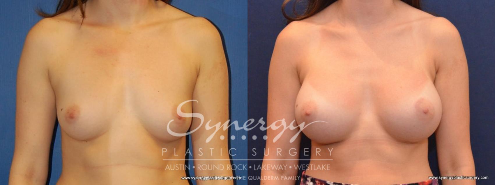 Before & After Breast Augmentation Case 448 View #1 View in Austin, TX