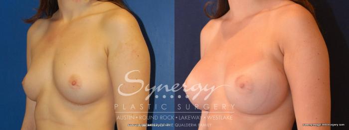 Before & After Breast Augmentation Case 448 View #7 View in Austin, TX
