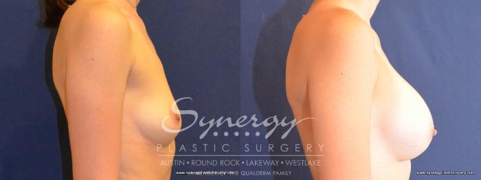 Before & After Breast Augmentation Case 450 View #2 View in Austin, TX