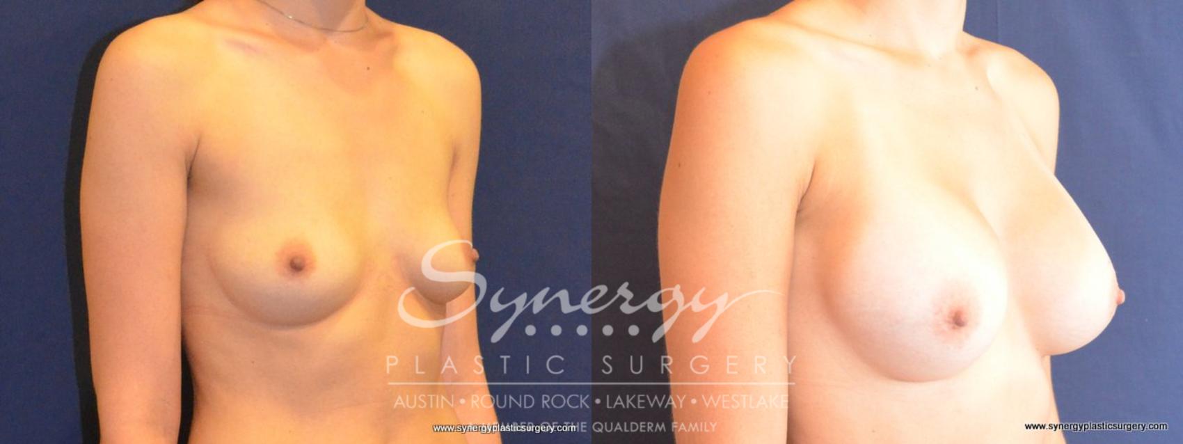 Before & After Breast Augmentation Case 450 View #3 View in Austin, TX