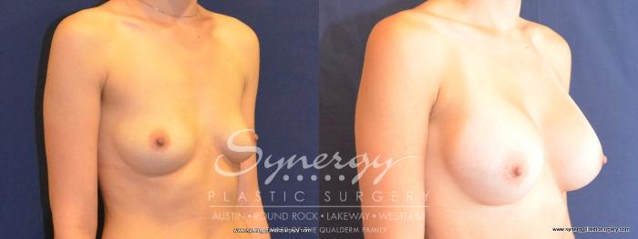 Before & After Breast Augmentation Case 450 View #3 View in Austin, TX