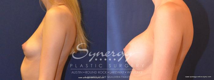 Before & After Breast Augmentation Case 452 View #2 View in Austin, TX
