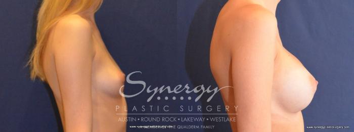 Before & After Breast Augmentation Case 452 View #4 View in Austin, TX