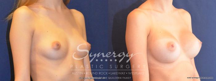 Before & After Breast Augmentation Case 452 View #5 View in Austin, TX