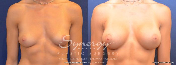 Before & After Breast Augmentation Case 453 View #1 View in Austin, TX