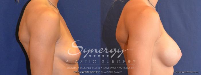 Before & After Breast Augmentation Case 453 View #2 View in Austin, TX