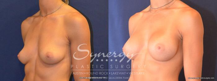 Before & After Breast Augmentation Case 453 View #5 View in Austin, TX