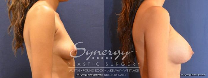 Before & After Breast Augmentation Case 457 View #2 View in Austin, TX
