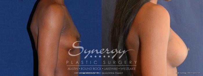 Before & After Breast Augmentation Case 458 View #2 View in Austin, TX