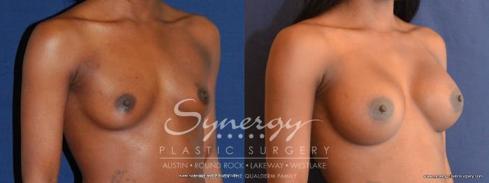 Before & After Breast Augmentation Case 458 View #3 View in Austin, TX