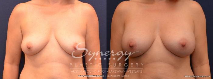 Before & After Breast Augmentation Case 459 View #1 View in Austin, TX