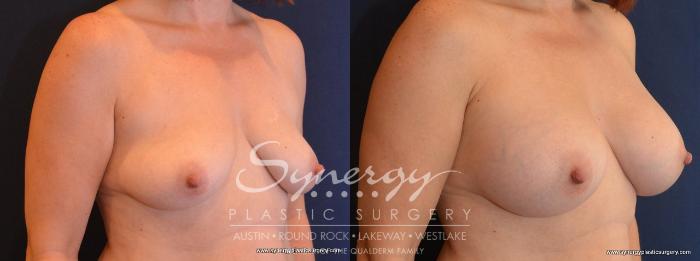 Before & After Breast Augmentation Case 459 View #4 View in Austin, TX
