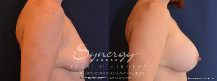 Before & After Breast Augmentation Case 459 View #5 View in Austin, TX