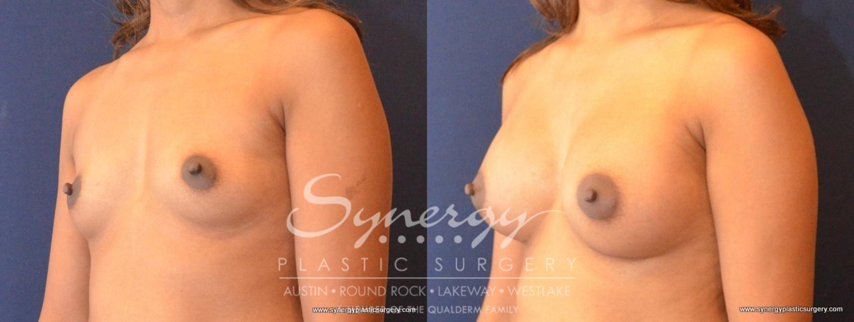 Before & After Breast Augmentation Case 461 View #1 View in Austin, TX