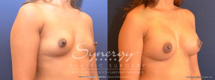 Before & After Breast Augmentation Case 461 View #3 View in Austin, TX