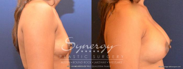 Before & After Breast Augmentation Case 461 View #4 View in Austin, TX