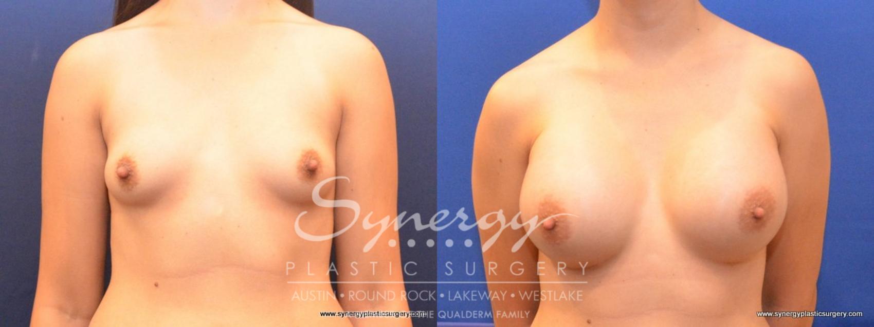 Before & After Breast Augmentation Case 464 View #1 View in Austin, TX