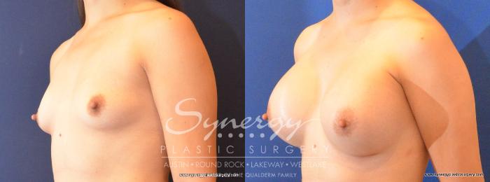Before & After Breast Augmentation Case 464 View #2 View in Austin, TX