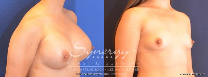 Before & After Breast Augmentation Case 464 View #4 View in Austin, TX