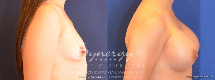 Before & After Breast Augmentation Case 464 View #5 View in Austin, TX