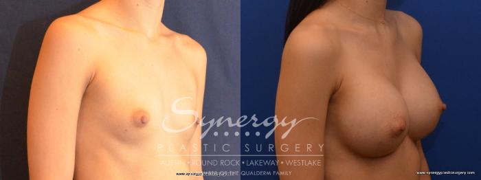 Before & After Breast Augmentation Case 466 View #2 View in Austin, TX