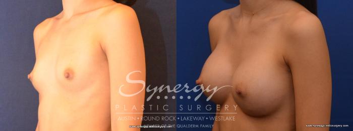 Before & After Breast Augmentation Case 466 View #4 View in Austin, TX