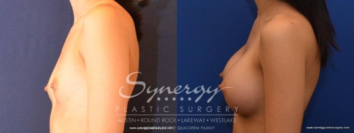 Before & After Breast Augmentation Case 466 View #5 View in Austin, TX