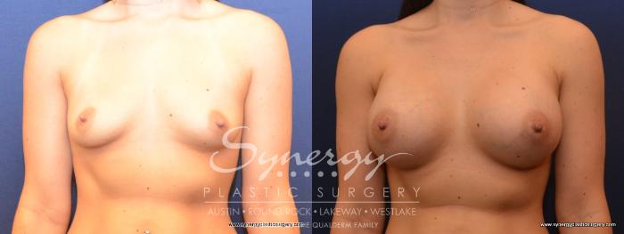 Before & After Breast Augmentation Case 468 View #1 View in Austin, TX
