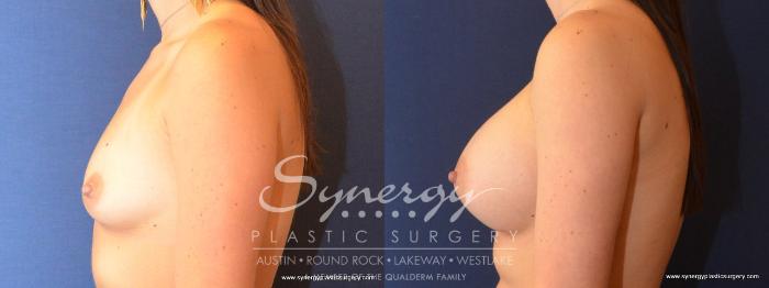 Before & After Breast Augmentation Case 468 View #2 View in Austin, TX