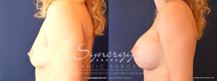 Before & After Breast Augmentation Case 474 View #3 View in Austin, TX
