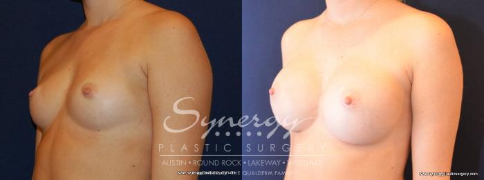 Before & After Breast Augmentation Case 475 View #2 View in Austin, TX