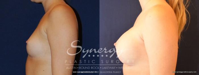 Before & After Breast Augmentation Case 475 View #3 View in Austin, TX