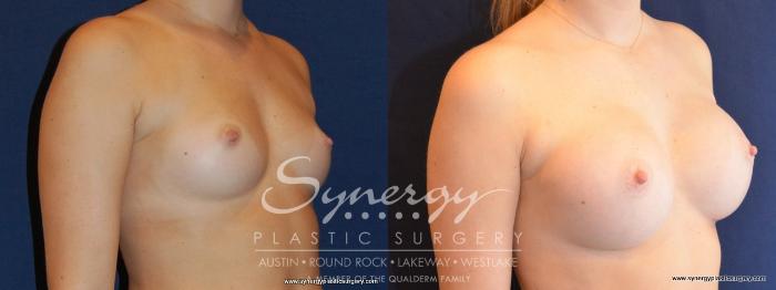 Before & After Breast Augmentation Case 475 View #4 View in Austin, TX