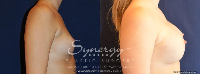 Before & After Breast Augmentation Case 475 View #5 View in Austin, TX