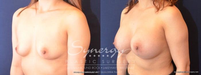 Before & After Breast Augmentation Case 476 View #5 View in Austin, TX