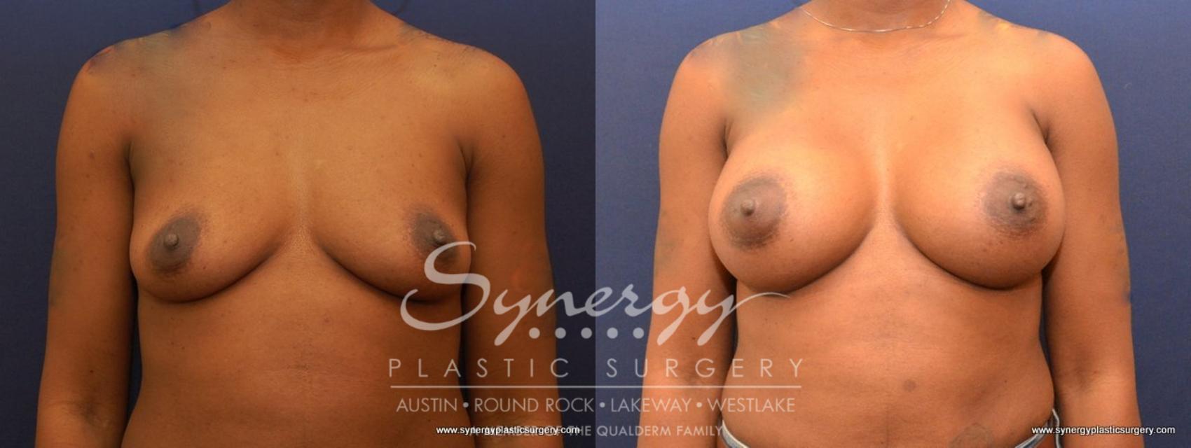 Before & After Breast Augmentation Case 477 View #1 View in Austin, TX