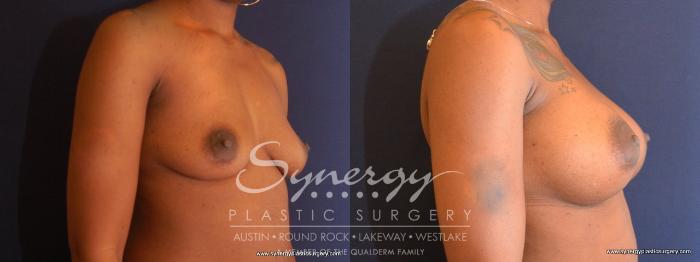 Before & After Breast Augmentation Case 477 View #4 View in Austin, TX