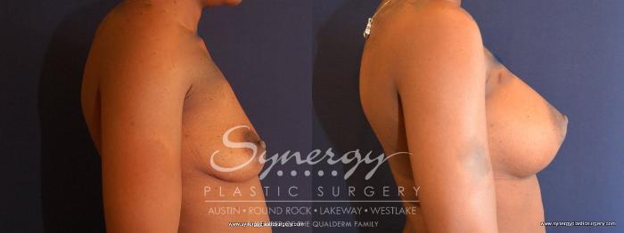 Before & After Breast Augmentation Case 477 View #5 View in Austin, TX