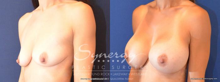Before & After Breast Augmentation Case 478 View #2 View in Austin, TX