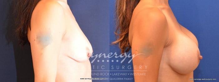 Before & After Breast Augmentation Case 478 View #5 View in Austin, TX